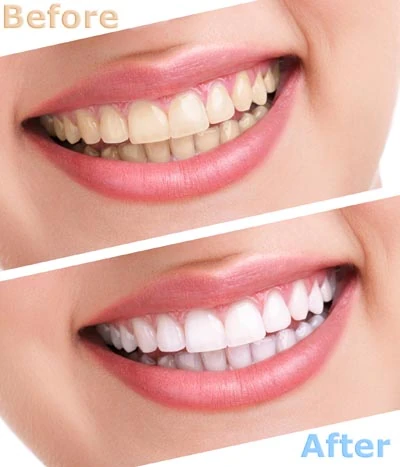 before and after look of teeth whitening services from Smile Studio Dentistry in Upland, CA