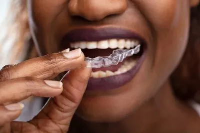 woman putting her new Invisalign clear aligners in